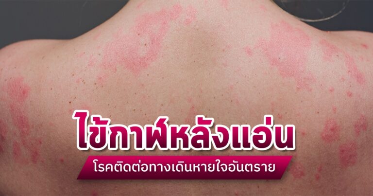 แพทย์เตือน “โรคไข้กาฬหลังแอ่น” อันตรายถึงชีวิตภายใน 24 ชม. แนะสังเกตอาการเร่งด่วน