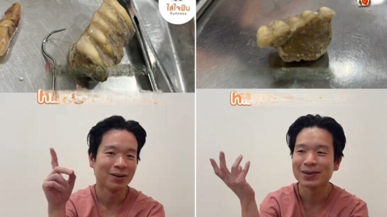 ขูดหินปูน เคสสุดสยองหลุดทั้งแผง หมอฟันเตือนเสี่ยงสูญเสียฟันแท้