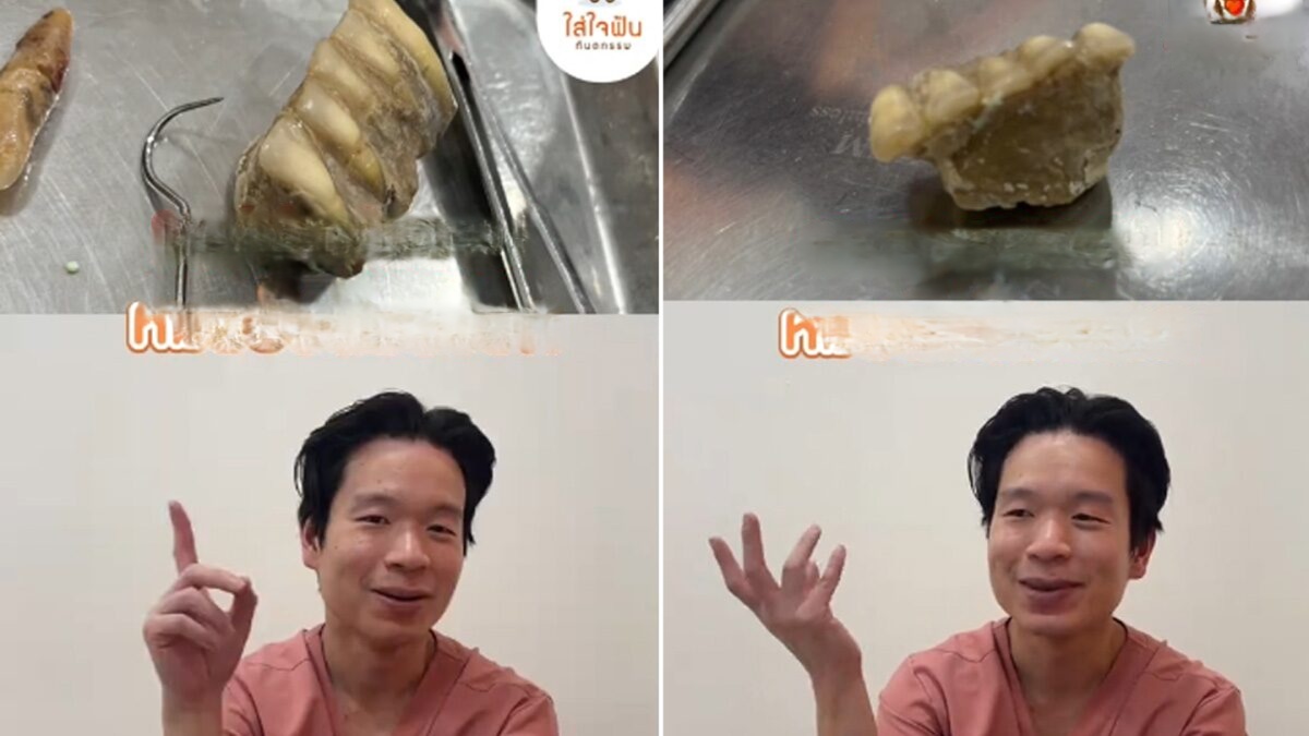 ขูดหินปูน เคสสุดสยองหลุดทั้งแผง หมอฟันเตือนเสี่ยงสูญเสียฟันแท้